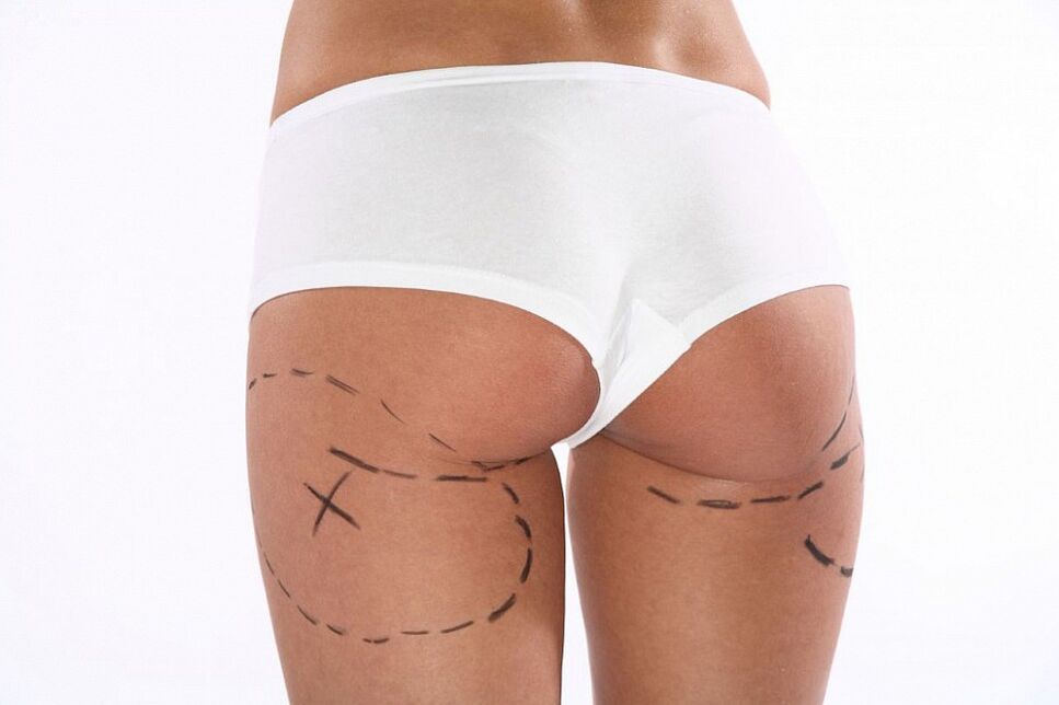 Cosmetic procedures to lose weight.